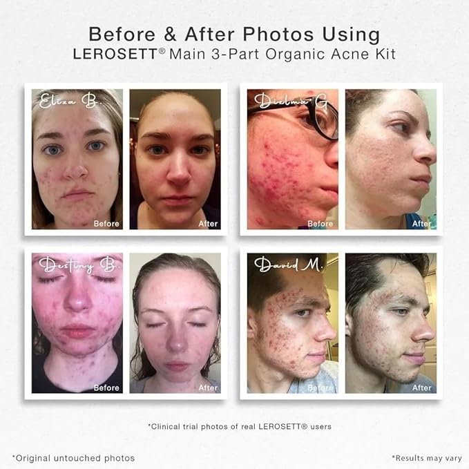 LEROSETT Acne Kit Includes Cleanser Moisturizer & Spot Treatment Mask Organic Calming Aloe & Clay Based, Clears Acne, Pimples, Blackheads & Breakouts, Vegan Acne Kit, For All Skin Types