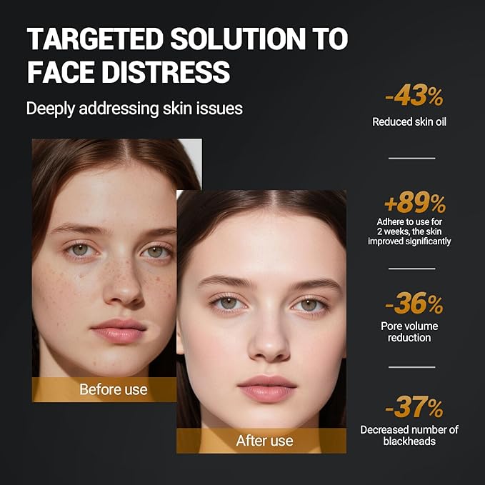 Purifying Kaolin Clay Mask & Mud Face Mask - Blackhead Remover, Oil Control for Sensitive/Oily/Dry Skin | Detoxifying Scrub & Pore Cleaner | Helps Reduce Pores & Acne | 10.5oz