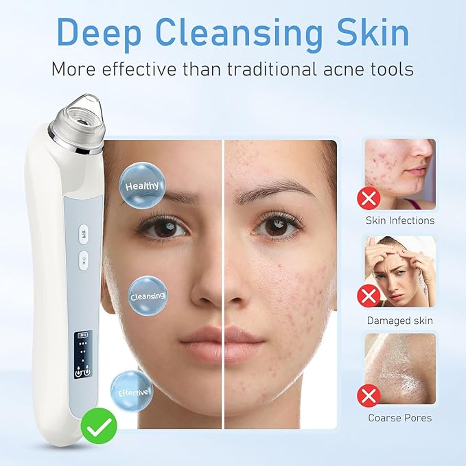 Facial Pore Blackhead Remover Vacuum, 1080P Camera Blackhead Remover, 20x Zoom, 8 LEDs ＆ 3 Suction Modes, 800mAh Battery & USB - 6 Heads Pore Cleaner Kit for Women&Men(White)