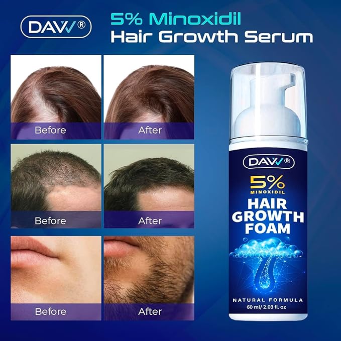 5% Minoxidil Foam for Women and Men Hair Growth: Minoxidil for Women Hair Growth - Minoxidil for Men - Extra Strength Hair Regrowth Treatment - Hair Growth Serum for Faster Stronger Thicker - 60ML