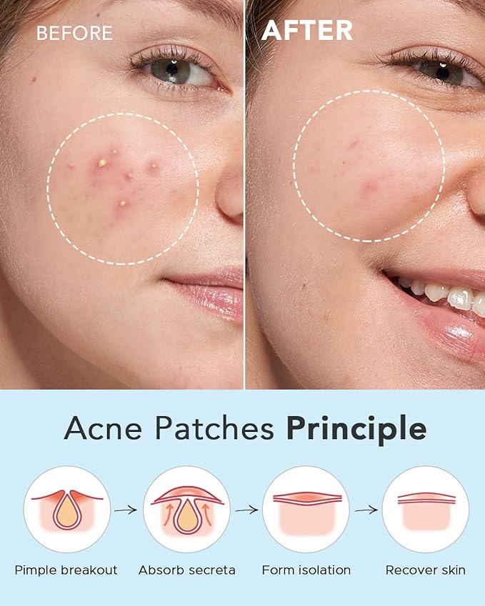 LitBear Acne Pimple Patches- Day and Night 6 Sizes 204 Dots Thin & Thick Hydrocolloid Patches with Witch Hazel, Tea Tree & Calendula Oil, Extra Adhesion for Face Zit Patch Dots