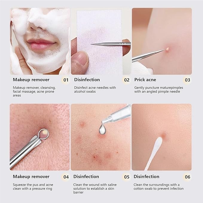 9 - Piece Stainless Steel Acne Tool Set - Complete Kit with Ultra - Sharp Tweezers, Needles for Effective Blackhead & Acne Removal