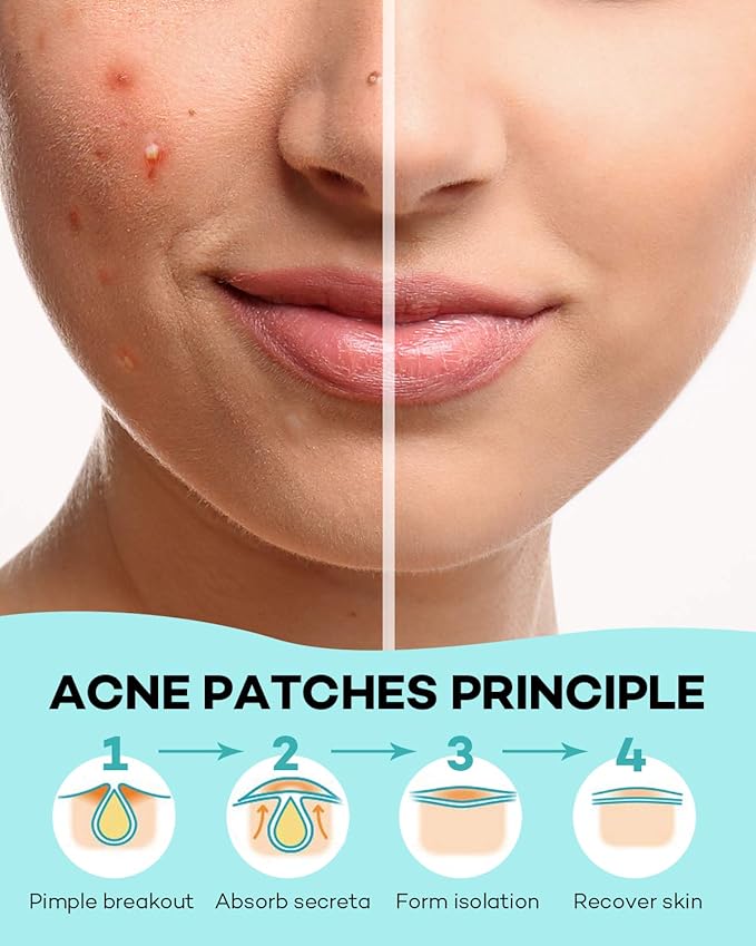 TKTK Pimple Patch Acne Patch, 4 Sizes 420 Patches Acne Absorbing Cover Patch, Hydrocolloid Invisible Acne Patches For Face Zit Patch Acne Dots Tea Tree, Calendula Oil - 3 Pack