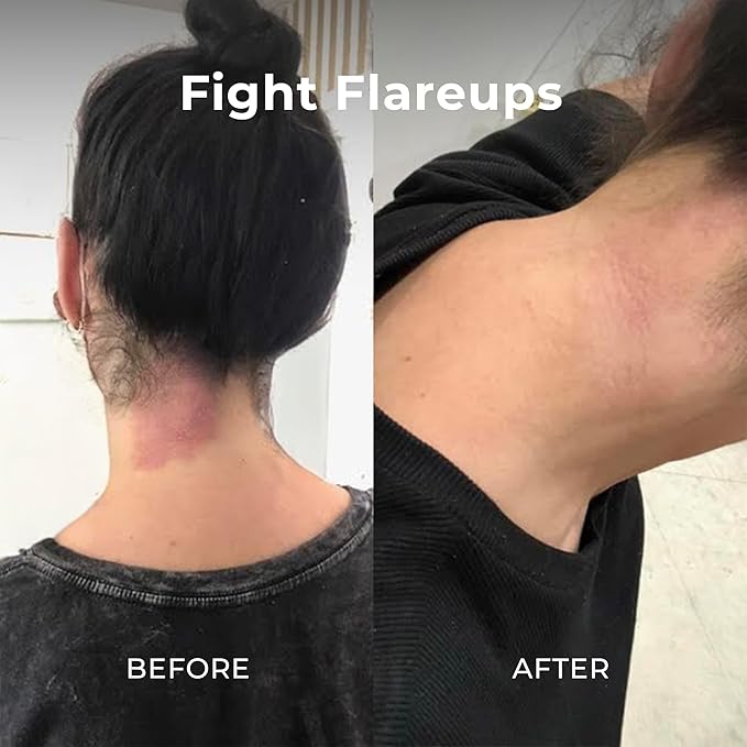 Miami Beach Bum, Bum + Body Cream Mint 6.7oz, Daily Moisturizer For Total Skin Health, Body Acne Treatment, Razor Bumps, Keratosis Pilaris, Ingrown Hairs, Sunburns, Blemishes & More..