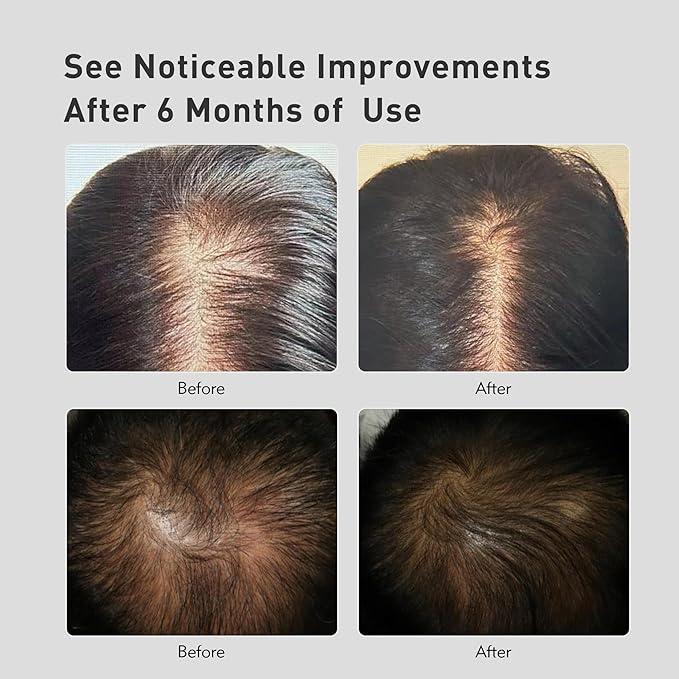 KINTOR 0.5% 0.9% KX-826 Hair Regrowth Spray,Reduce Fuller-looking Healthier Hair,Oil Control, Hair Care Products Group for Men&Women,3 Bottles, Basic,Plant-Based,Pro