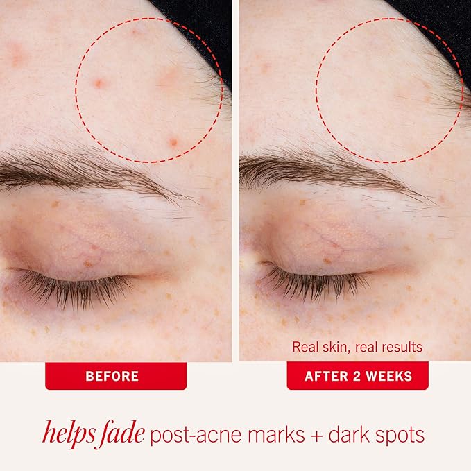 First Aid Beauty Lactic Acid Lotion for Acne-Prone Skin with 2% Niacinamide - Resurfacing Lotion Moisturizes & Visibly Diminishes Post-Acne Marks, (1.0 oz)