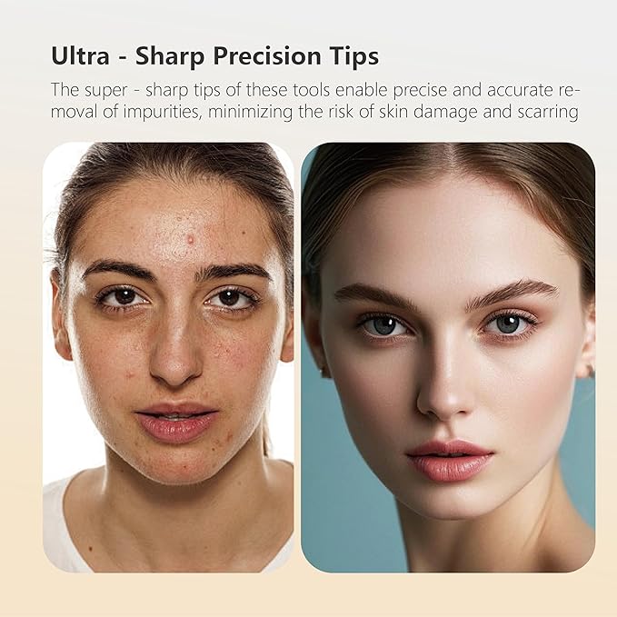 9 - Piece Stainless Steel Acne Tool Set - Complete Kit with Ultra - Sharp Tweezers, Needles for Effective Blackhead & Acne Removal