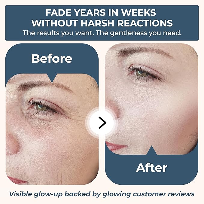 Véraglo Retinol Serum & Face Cream Set – Anti Aging Skin Care with Hyaluronic Acid & Collagen – Moisturizer & Serum for Wrinkles, Fine Lines & Dark Circles